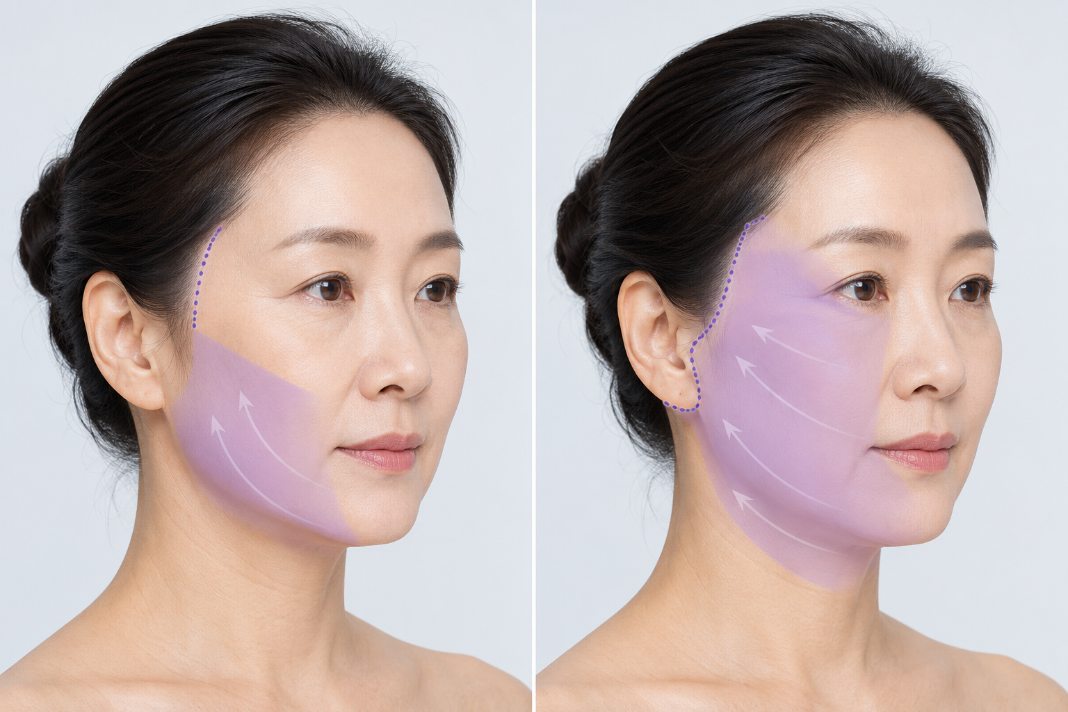 리팅성형외과-서울점_미니리프팅_안면거상_리프팅적용범위_리프팅효과.png %EB%A6%AC%ED%8C%85%EC%84%B1%ED%98%95%EC%99%B8%EA%B3%BC-%EC%84%9C%EC%9A%B8%EC%A0%90_%EB%AF%B8%EB%8B%88%EB%A6%AC%ED%94%84%ED%8C%85_%EC%95%88%EB%A9%B4%EA%B1%B0%EC%83%81_%EB%A6%AC%ED%94%84%ED%8C%85%EC%A0%81%EC%9A%A9%EB%B2%94%EC%9C%84_%EB%A6%AC%ED%94%84%ED%8C%85%ED%9A%A8%EA%B3%BC.png
