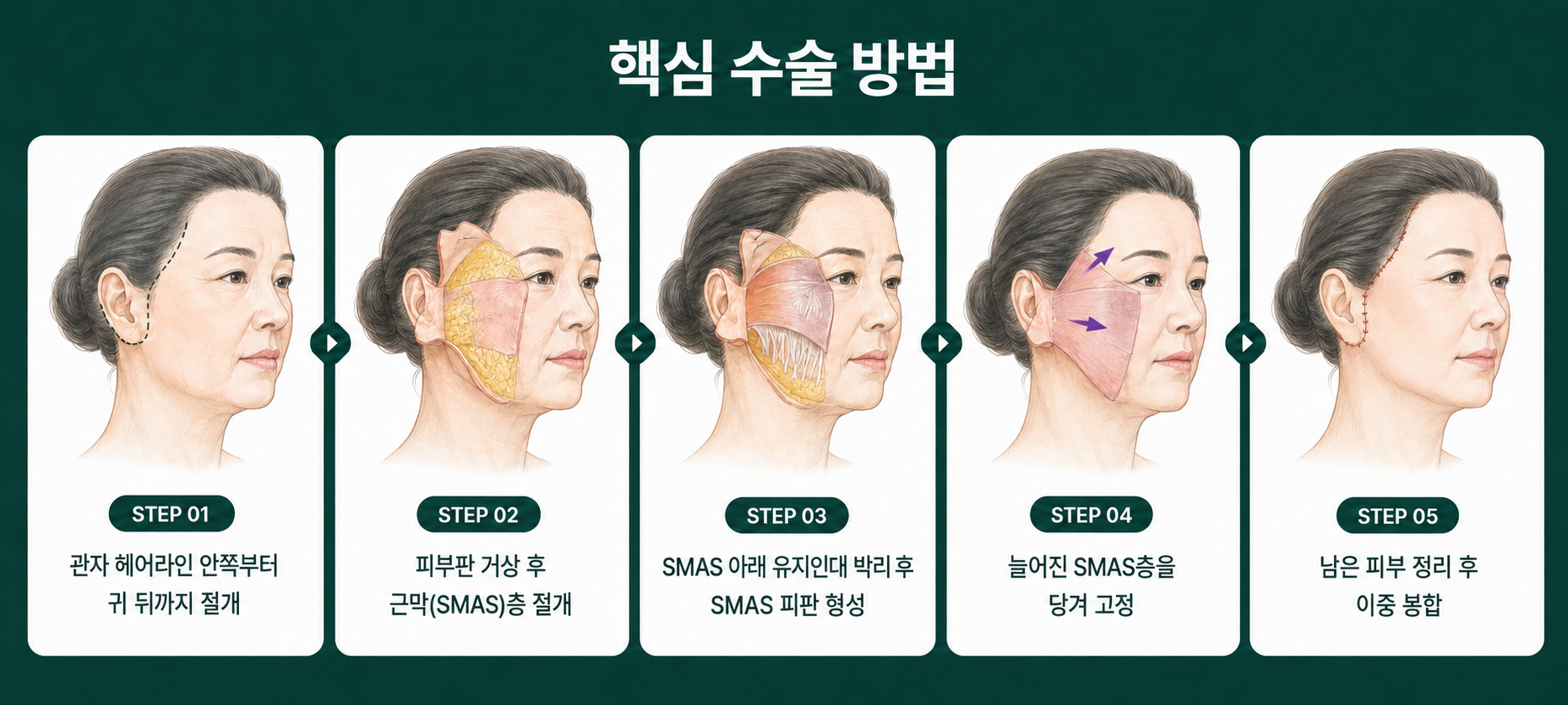 리팅성형외과_안면거상방법_안면거상수술후기.png %EB%A6%AC%ED%8C%85%EC%84%B1%ED%98%95%EC%99%B8%EA%B3%BC_%EC%95%88%EB%A9%B4%EA%B1%B0%EC%83%81%EB%B0%A9%EB%B2%95_%EC%95%88%EB%A9%B4%EA%B1%B0%EC%83%81%EC%88%98%EC%88%A0%ED%9B%84%EA%B8%B0.png