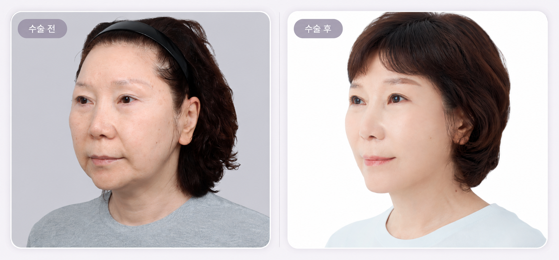 리팅성형외과_중안면하안면_안면거상-후기_리프팅효과.png %EB%A6%AC%ED%8C%85%EC%84%B1%ED%98%95%EC%99%B8%EA%B3%BC_%EC%A4%91%EC%95%88%EB%A9%B4%ED%95%98%EC%95%88%EB%A9%B4_%EC%95%88%EB%A9%B4%EA%B1%B0%EC%83%81-%ED%9B%84%EA%B8%B0_%EB%A6%AC%ED%94%84%ED%8C%85%ED%9A%A8%EA%B3%BC.png