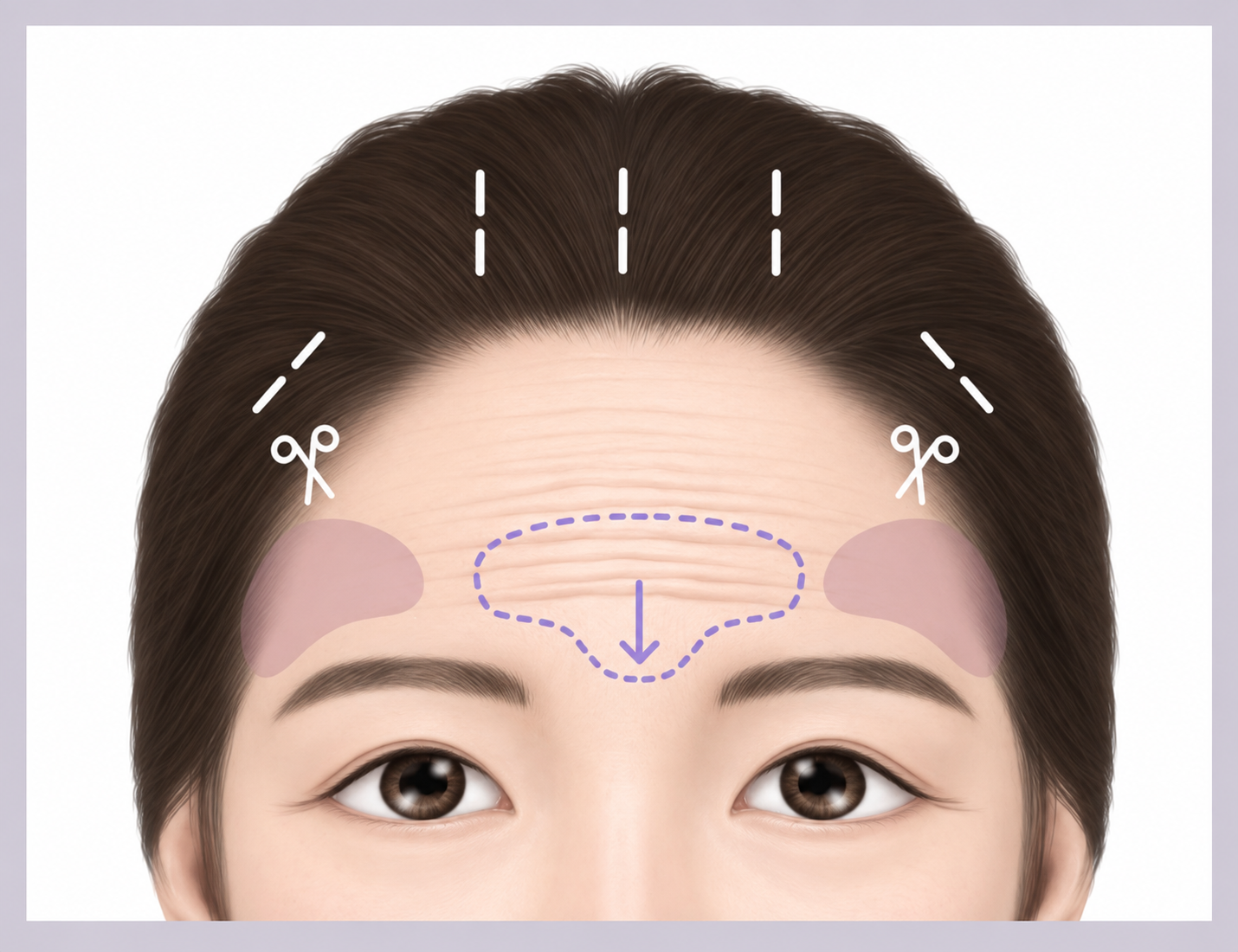 리팅성형외과_내시경이마거상.png %EB%A6%AC%ED%8C%85%EC%84%B1%ED%98%95%EC%99%B8%EA%B3%BC_%EB%82%B4%EC%8B%9C%EA%B2%BD%EC%9D%B4%EB%A7%88%EA%B1%B0%EC%83%81.png