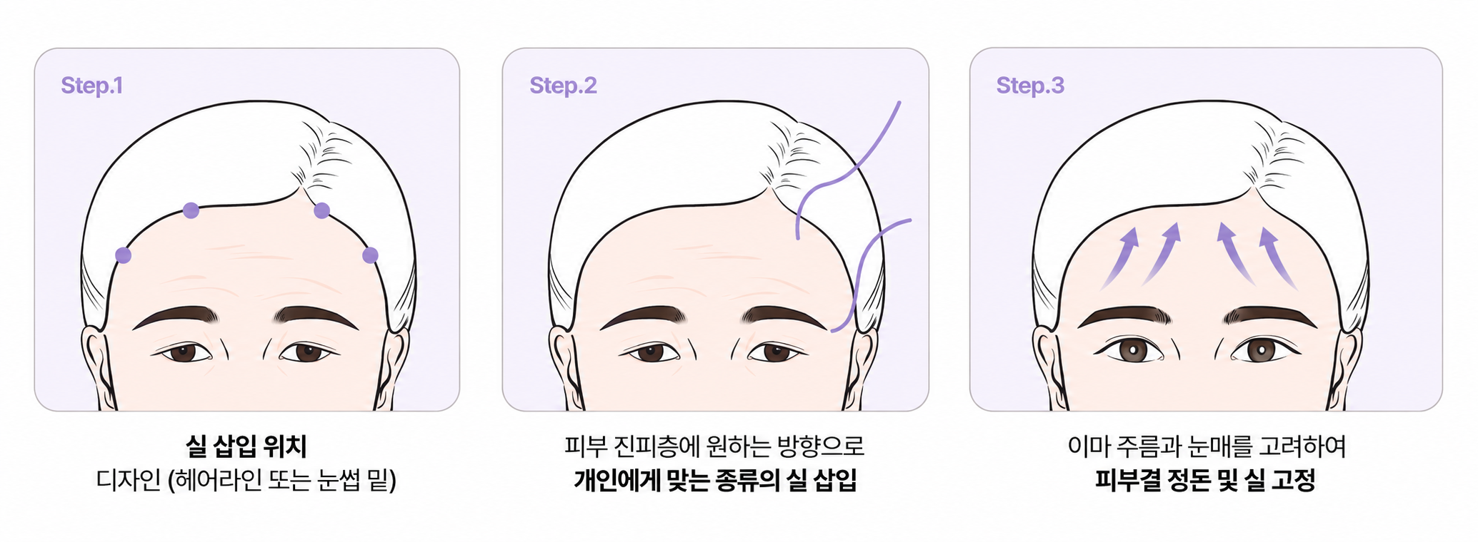 리팅성형외과_내시경이마거상_수술방법.png %EB%A6%AC%ED%8C%85%EC%84%B1%ED%98%95%EC%99%B8%EA%B3%BC_%EB%82%B4%EC%8B%9C%EA%B2%BD%EC%9D%B4%EB%A7%88%EA%B1%B0%EC%83%81_%EC%88%98%EC%88%A0%EB%B0%A9%EB%B2%95.png