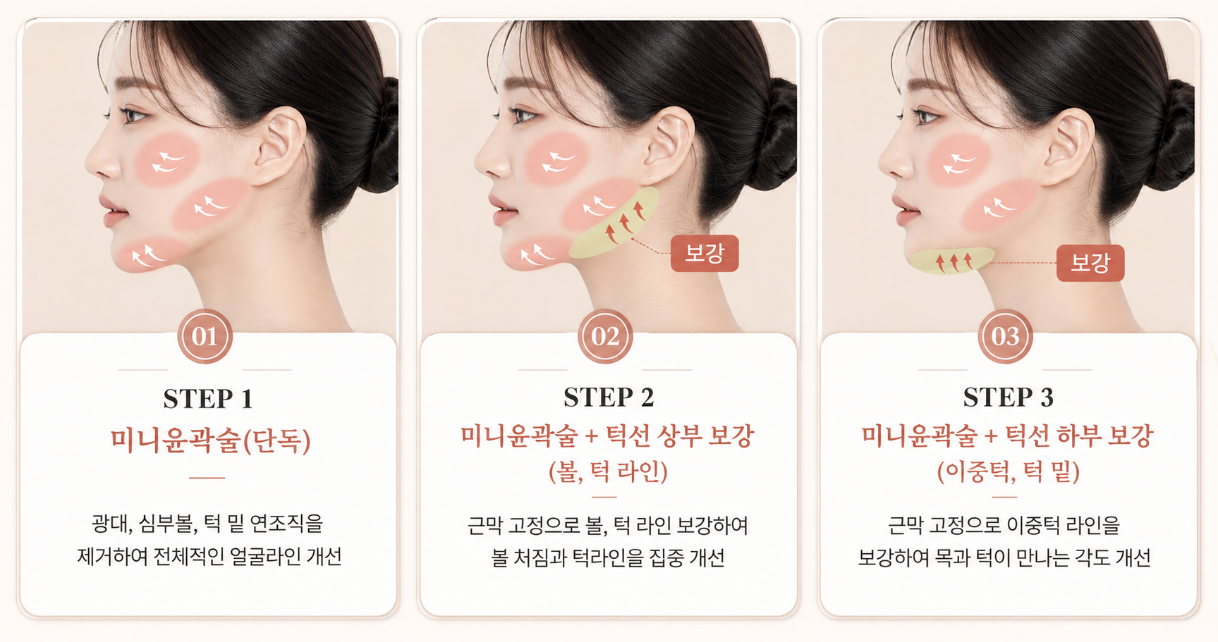 리팅성형외과_미니윤곽술_단계별방법_이중턱.png %EB%A6%AC%ED%8C%85%EC%84%B1%ED%98%95%EC%99%B8%EA%B3%BC_%EB%AF%B8%EB%8B%88%EC%9C%A4%EA%B3%BD%EC%88%A0_%EB%8B%A8%EA%B3%84%EB%B3%84%EB%B0%A9%EB%B2%95_%EC%9D%B4%EC%A4%91%ED%84%B1.png