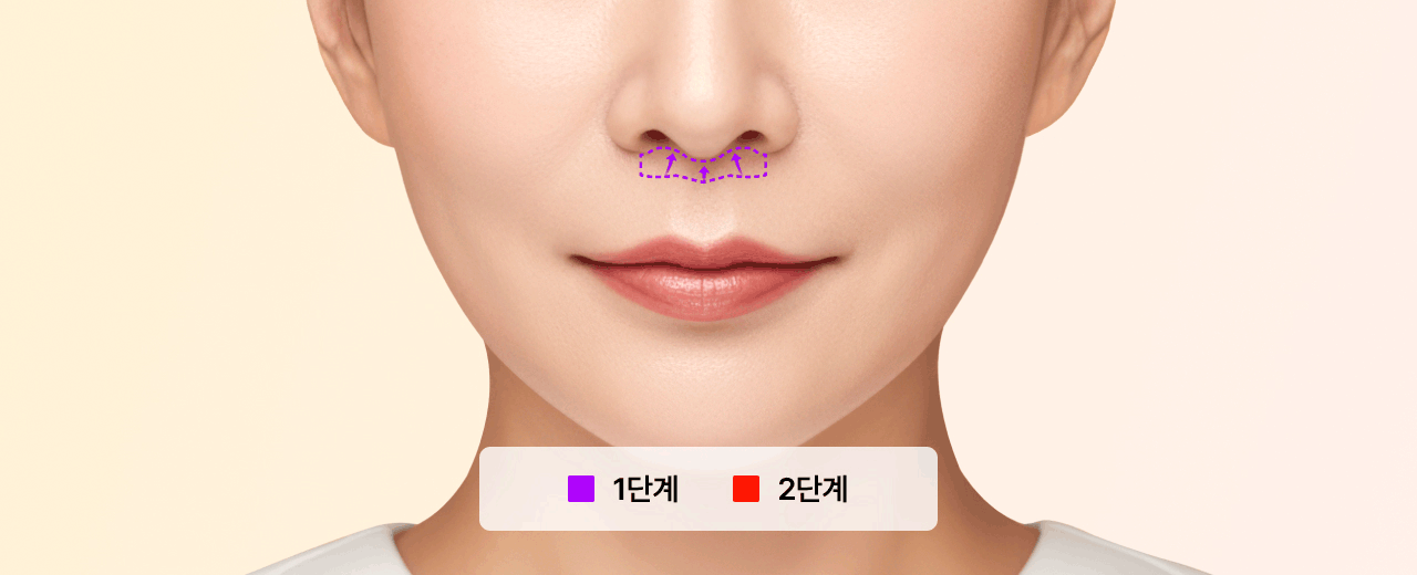 리팅성형외과_인중축소술_수술단계.gif %EB%A6%AC%ED%8C%85%EC%84%B1%ED%98%95%EC%99%B8%EA%B3%BC_%EC%9D%B8%EC%A4%91%EC%B6%95%EC%86%8C%EC%88%A0_%EC%88%98%EC%88%A0%EB%8B%A8%EA%B3%84.gif