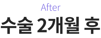 After 수술 2개월 후