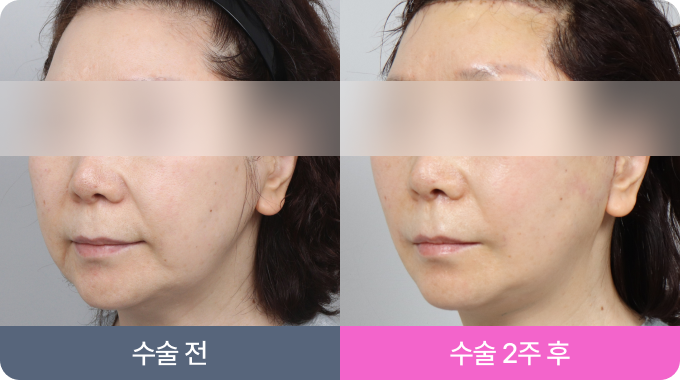 리팅 안면거상 리얼 후기02