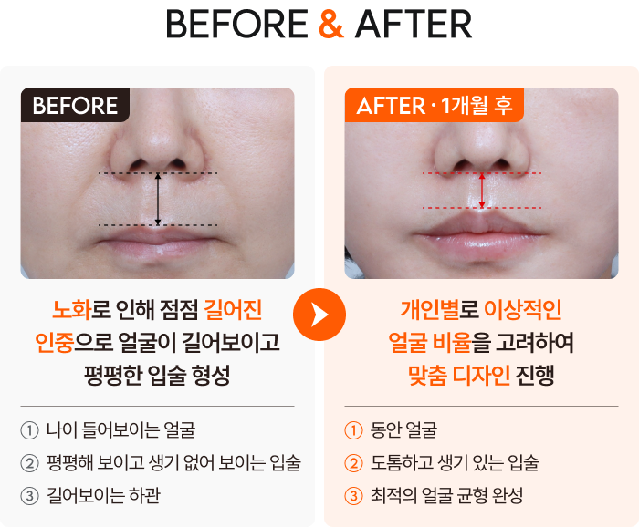 인중축소술 Before & After