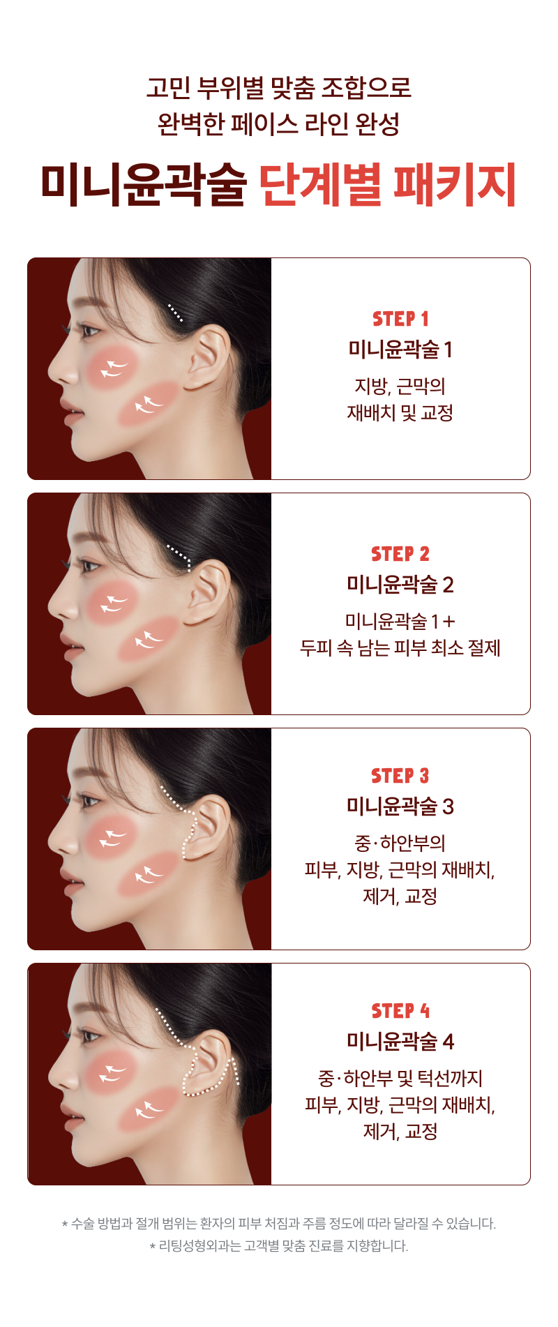 미니윤곽술 단계별 리프팅 패키지