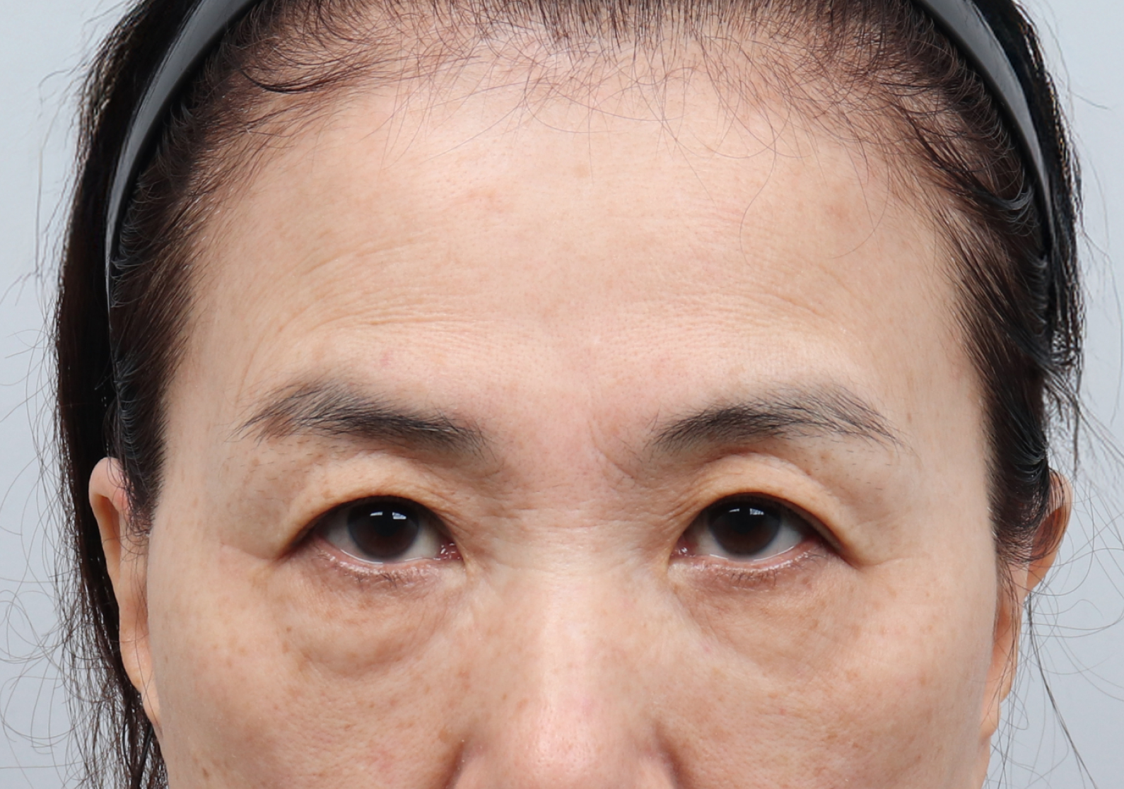 upper_03_before