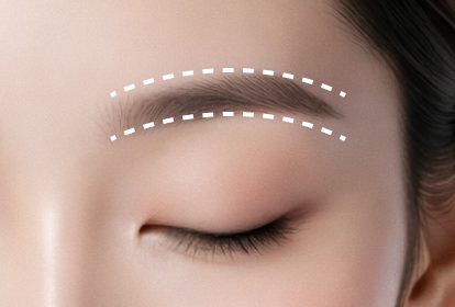 매직아이+눈썹거상술