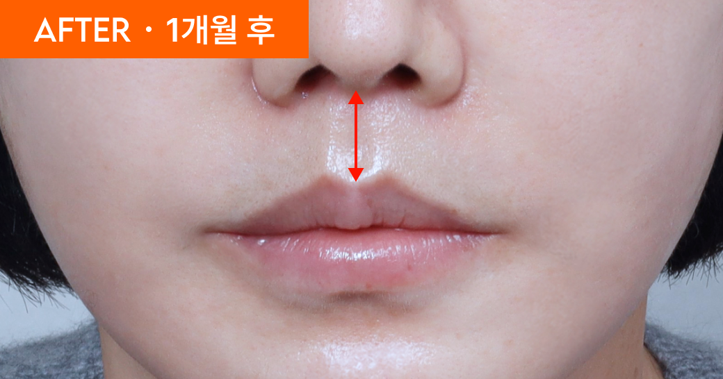 AFTER · 1개월 후