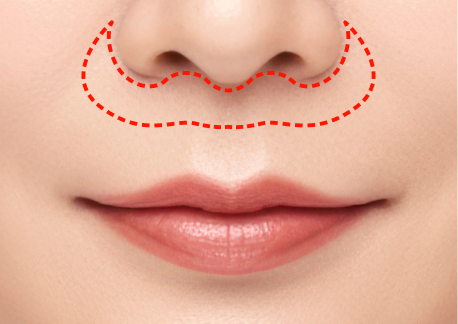 인중축소술 2단계 