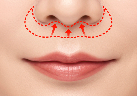 인중축소술 2단계 