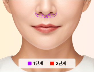 인중축소술이란?