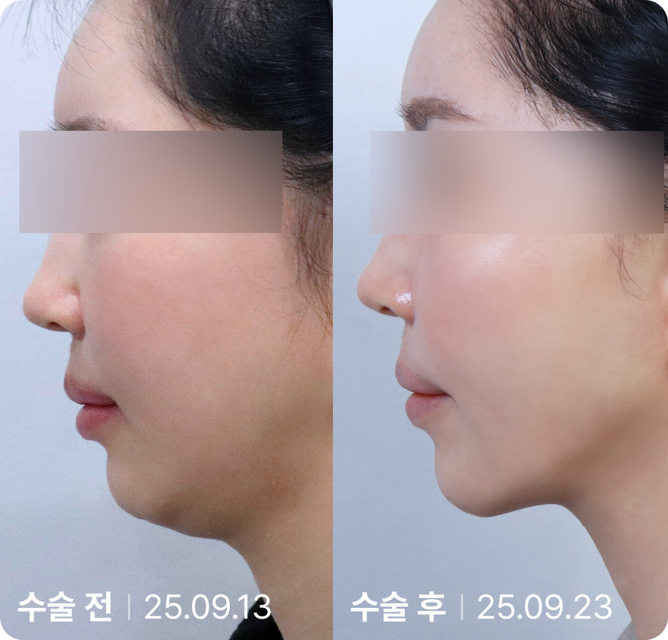 수술 전 | 수술 후