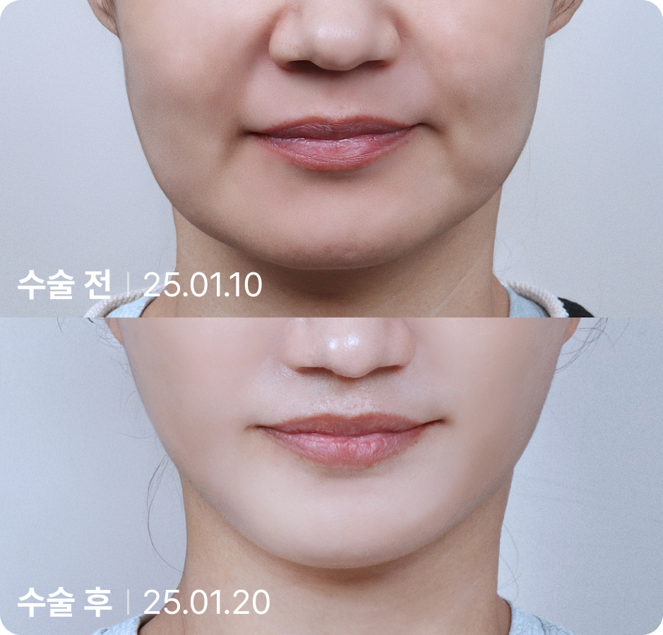 수술 전 | 수술 후