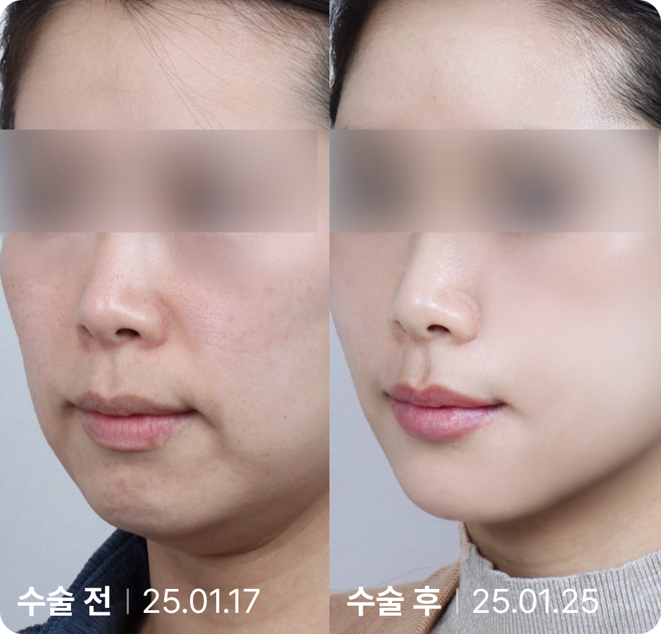 수술 전 | 수술 후