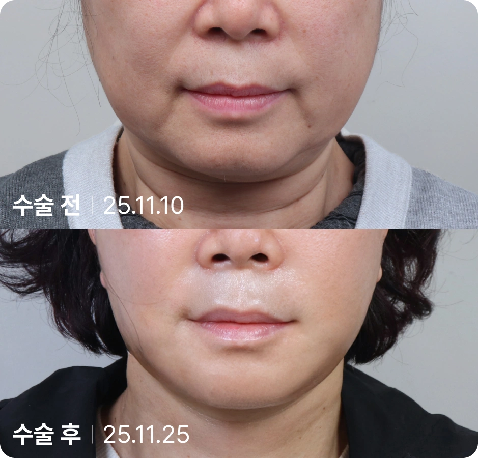 수술 전 | 수술 후