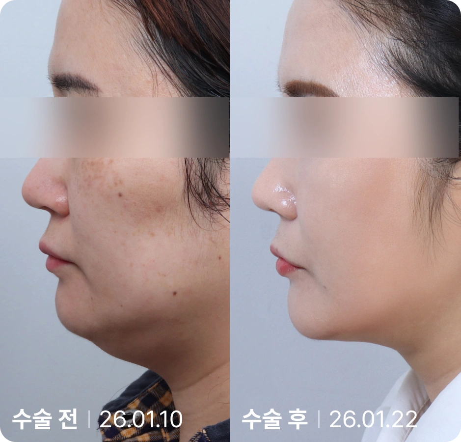 수술 전 | 수술 후