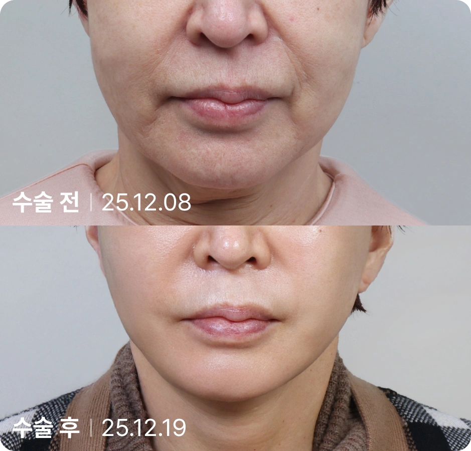 수술 전 | 수술 후