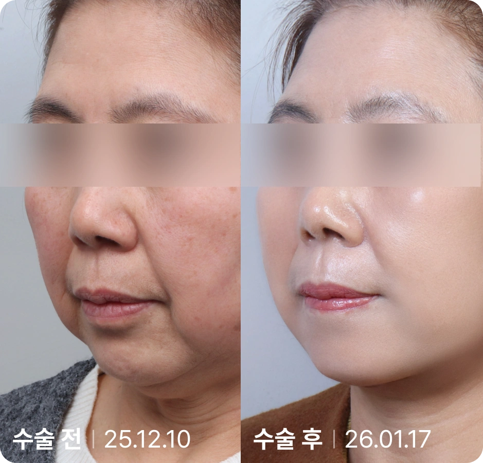 수술 전 | 수술 후
