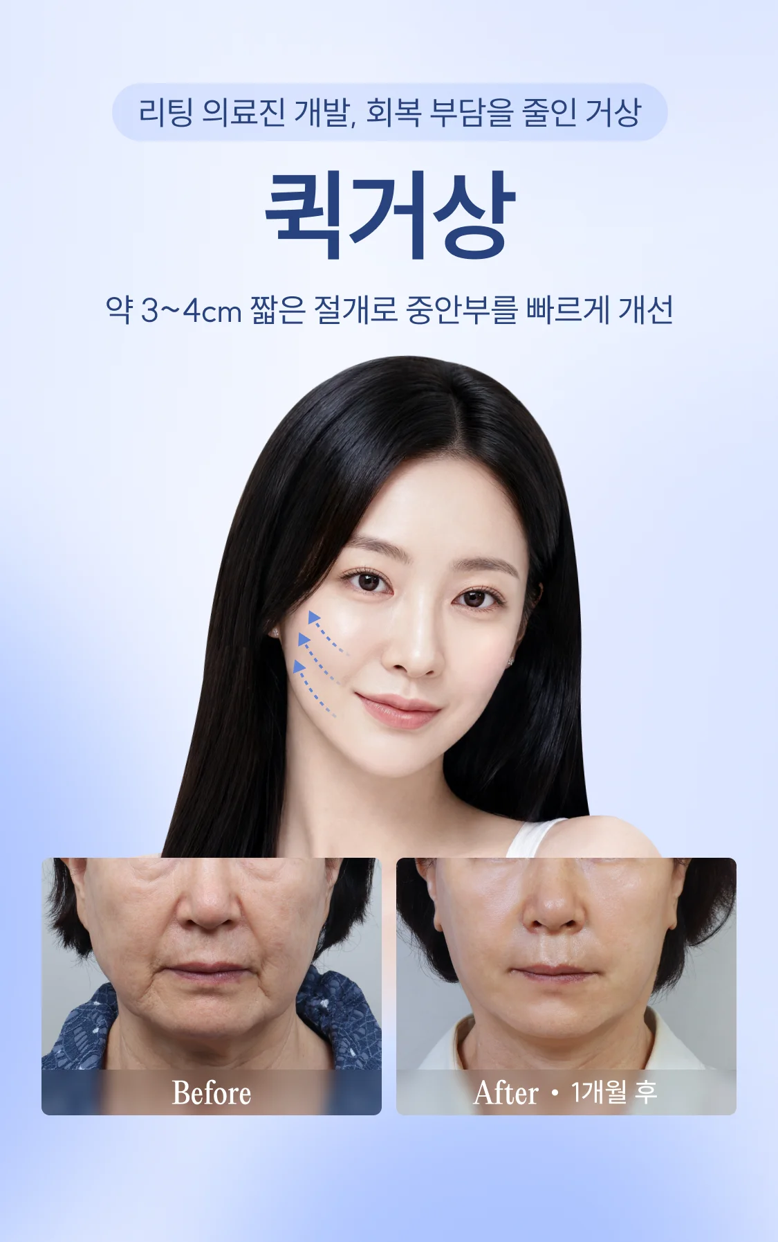 약 3~4cm 짧은 절개로 중안부를 빠르게 개선 퀵거상